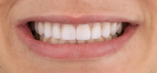 Depois - Dentes Pequenos